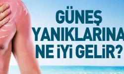 Güneş yanıklarına ne iyi gelir?