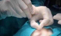 Çukurca’da gözyaşı kanalı ameliyatları yapılmaya başlandı