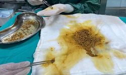 Bingöl’de nadir vaka: Safra kesesinden 2 bin 67 taş çıkarıldı