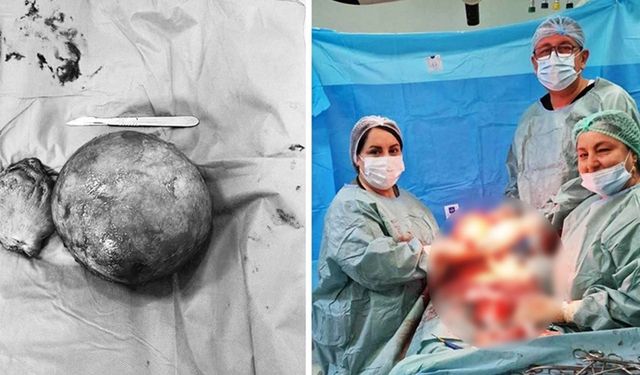 Genç kadının rahminden 25 santimetrelik ur çıkarıldı