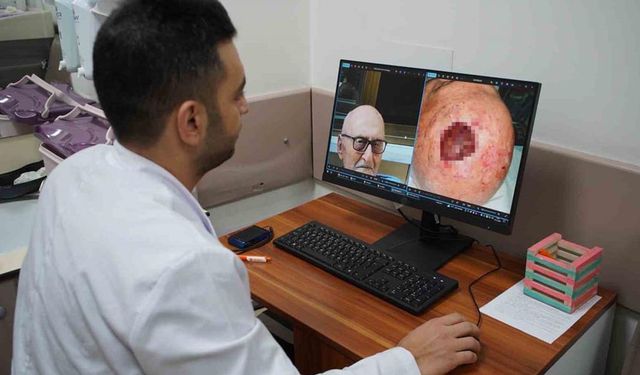Dünyada 3’üncü kez rastlandı: Saçlı derideki nadir tümör Sakarya’da tedavi edildi