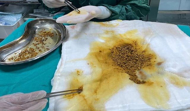 Bingöl’de nadir vaka: Safra kesesinden 2 bin 67 taş çıkarıldı