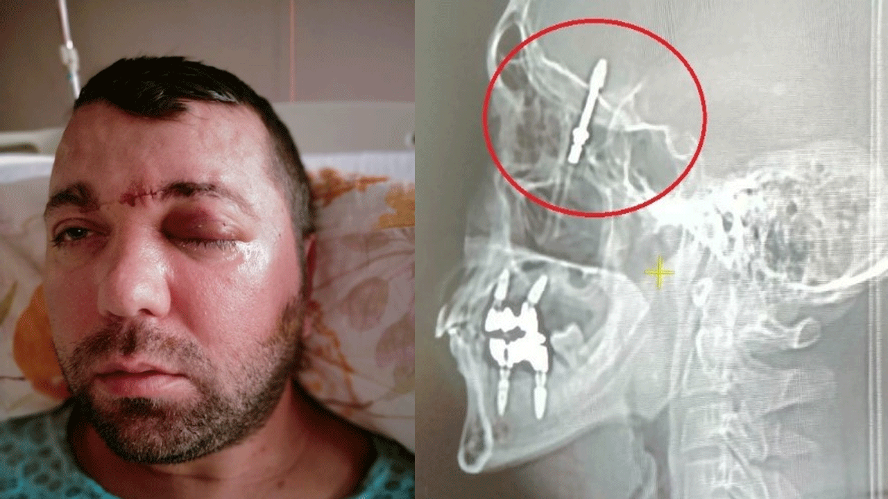 Dişçide yaptırdığı  implant Beynine saplandı! 2 yıldır adalet bekliyor